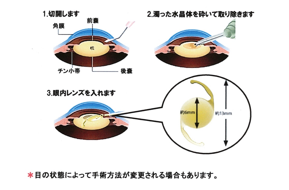 白内障手術とは